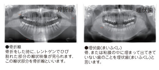 ●骨折線
骨折をした時に、レントゲンでひび
割れた部分の線状映像が見られます、
この線状部分を骨折線といいます。
●埋伏歯(まいふくし)
骨、または粘膜の中に埋まって出てきて
いない歯のことを埋伏歯(まいふくし)と
言います。